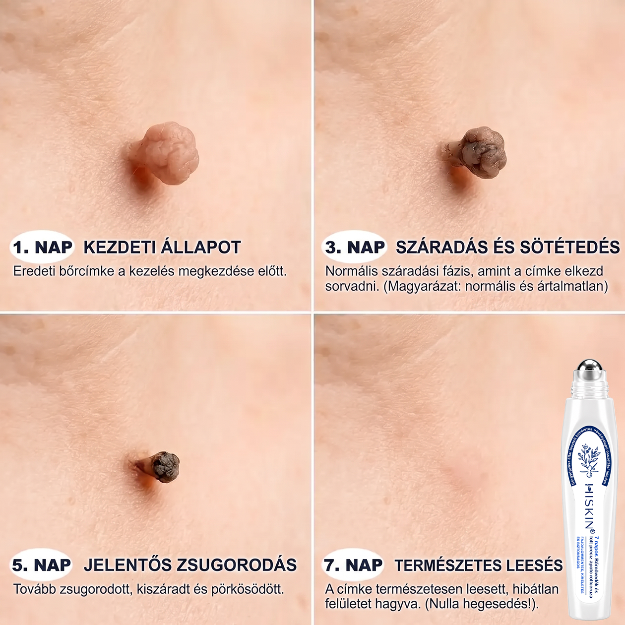 Hivatalos Márkabolt | 🚢 Hiskin® 7 napos Szemölcseltávolító Roll-on Ápoló Folyadék (Fájdalommentes rollerball technológia, hegek nélkül) 🐬