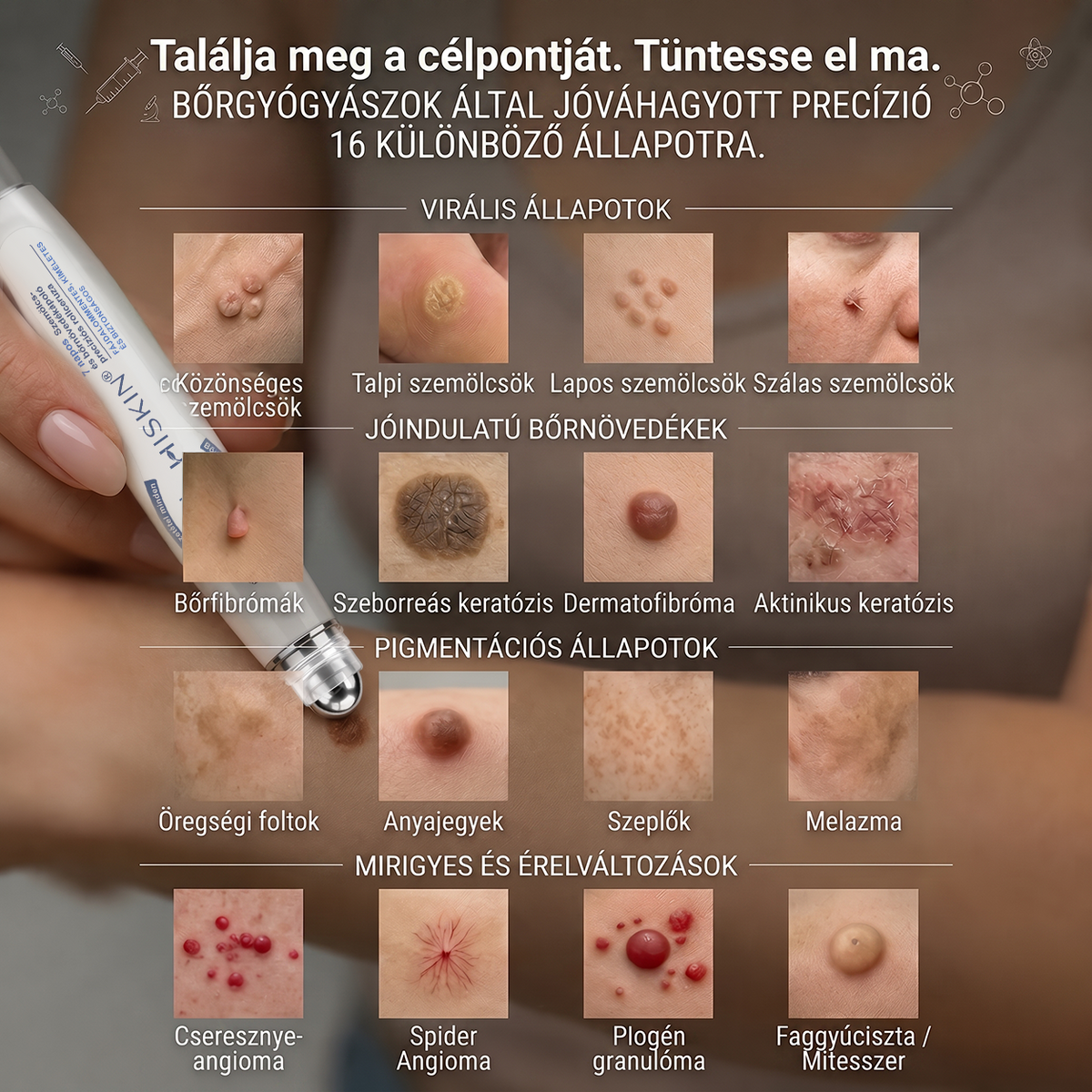 Hivatalos Márkabolt | 🚢 Hiskin® 7 napos Szemölcseltávolító Roll-on Ápoló Folyadék (Fájdalommentes rollerball technológia, hegek nélkül) 🐬