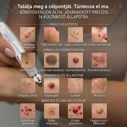 Hivatalos Márkabolt | 🚢 Hiskin® 7 napos Szemölcseltávolító Roll-on Ápoló Folyadék (Fájdalommentes rollerball technológia, hegek nélkül) 🐬